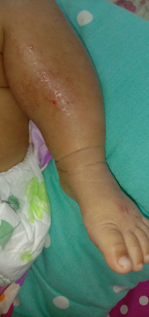 Bayi gatal-gatal sebadan