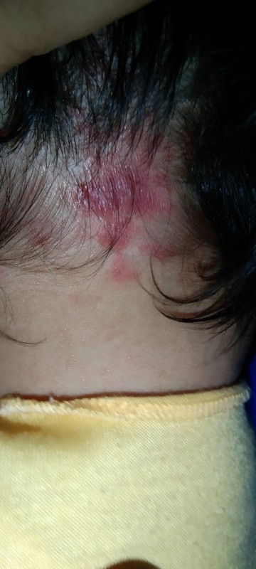 Ruam merah di kepala