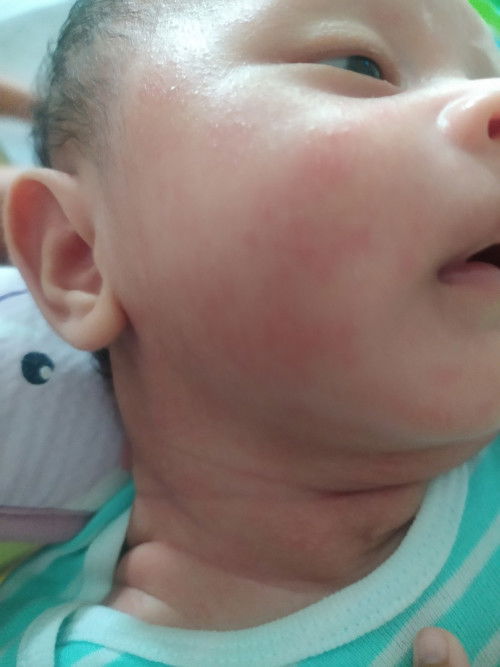 Bintik2 merah diwajah dan leher bayi