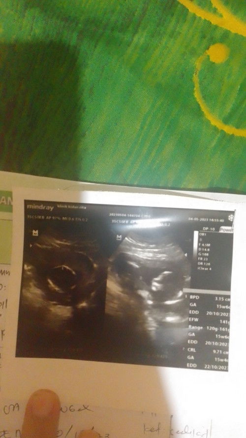 16 Minggu kekurangan ketuban