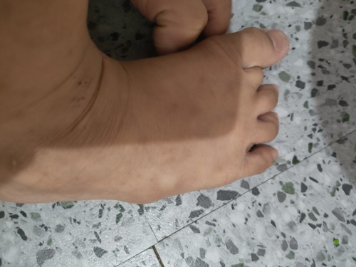 Bukol sa gilid ng paa