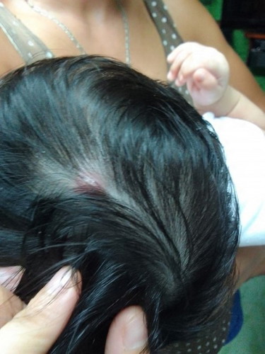 Bukol na pula sa ulo ni baby