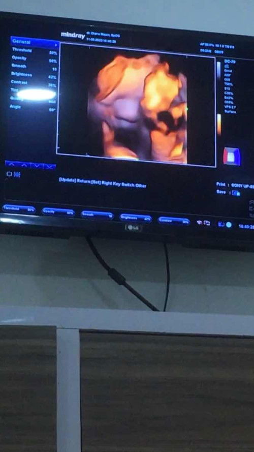 terlilit tali pusar 29w