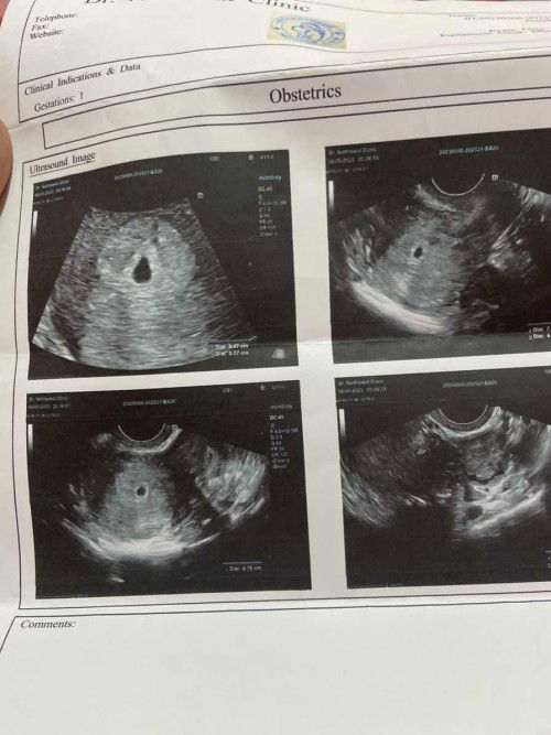 หมอบอกอายุครรภ์ประมาน3-4สัปดาห์เจอแต่ถุง