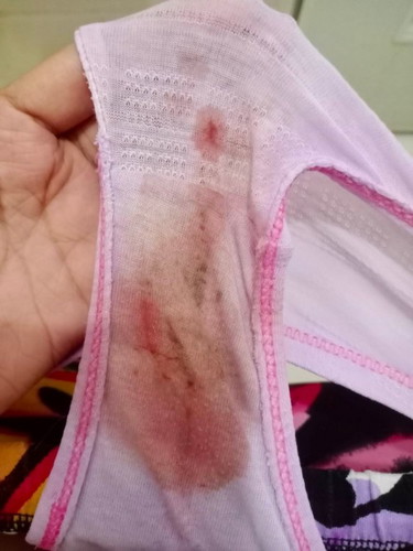 Spotting po or bleeding?