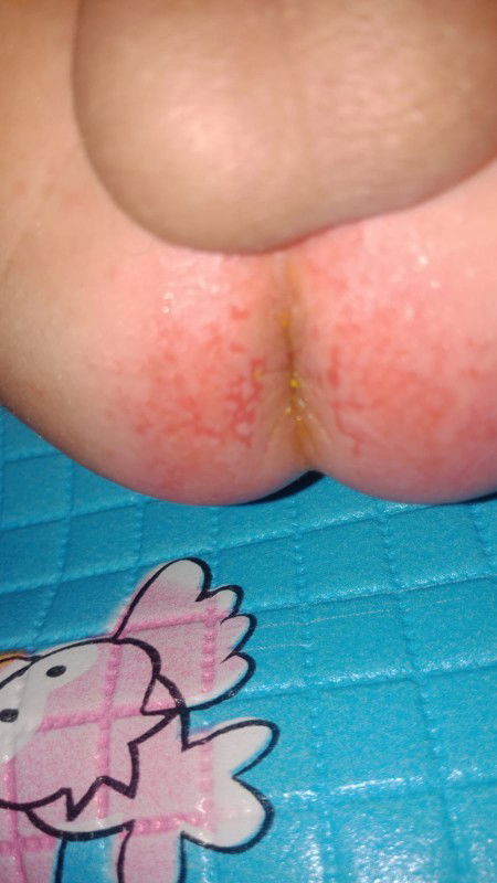 Ini ank sy serg pup tp dikit2.pntat ny uda sampe merh terkelupas gt.kbtlan ank sy Asi.ada yg samaan?