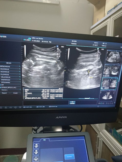 เพศลูก หมอบอกผมมีจู๋ครับ 31w2dน้ำหนัก1550