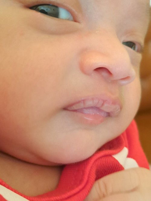 Bibir seperti melepuh