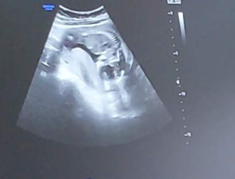Ultrasound 16 weeks