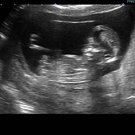 Baby's Gender