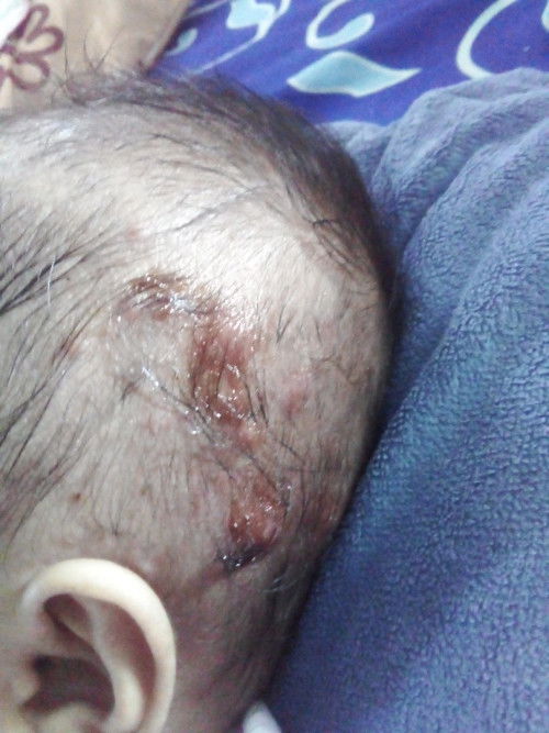 Anak sy usia 2 bulan sdh bisulan , sembuh satu tumbuh lagu dtmpat lain dan tambah banyak. Itu kenapa