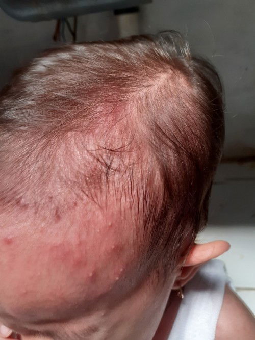 Ini keringet buntet atau alergi?