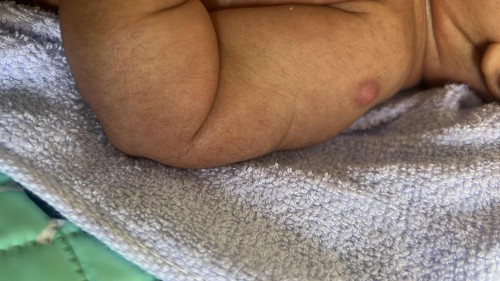 injection pada lengan anak