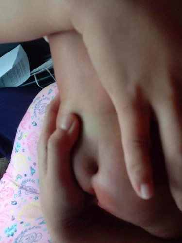 Fistula or sacral dimple