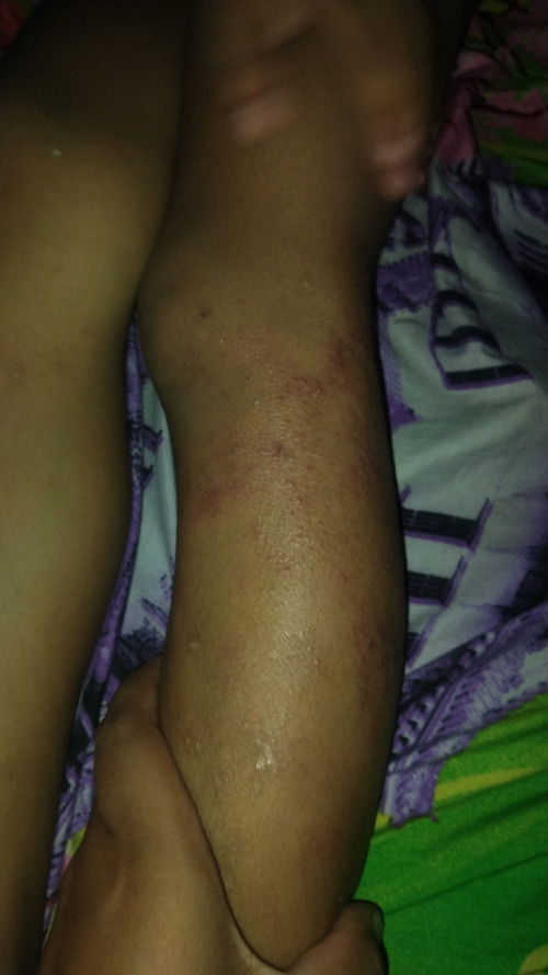 Mau tanya obat gatel yang aman buat bocah apa ya