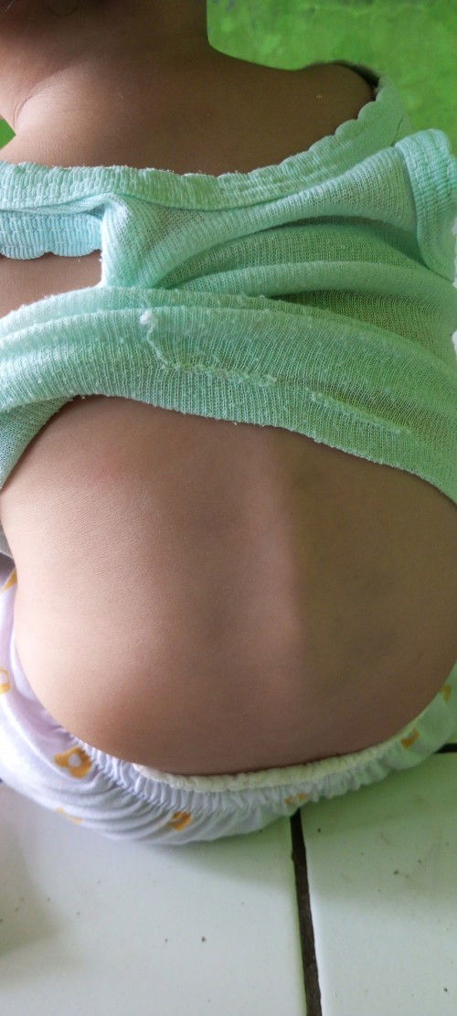Tulang punggung bayi terlalu menonjol