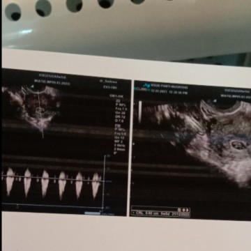 hamil 6minggu 5hari