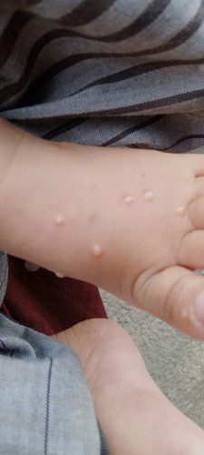 ada juga ga bund yg kaki anaknya bintik berair kayak gini kira kira kenapa ya