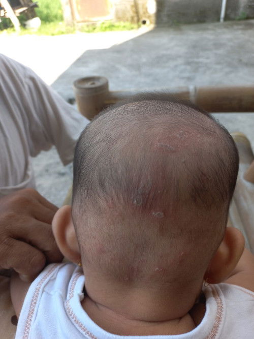 Kulit Kepala bayi seperti ruam
