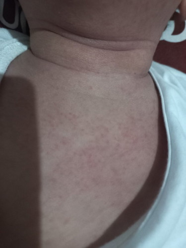 4 mos old rashes...