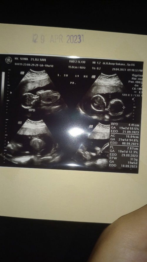 Bb normal janin kembar uk 19w