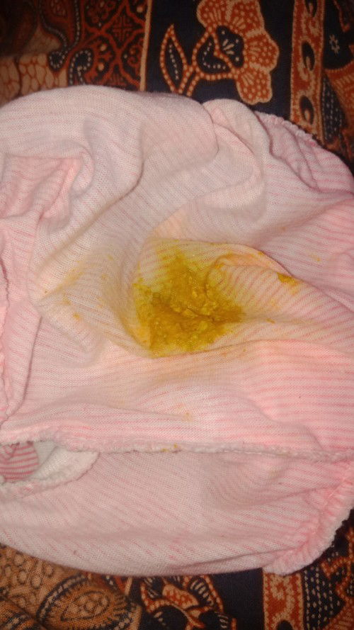 Ankku asi tp tiap hari pup dikit2 gini sampe pntat ny merah apa normal y?ato diare? Ada yg samaan
