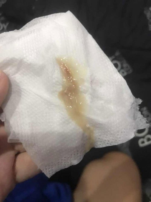 แบบนี้ต้องไปหาหมอเลยไหม  หรือรอให้ปวดท้องก่อน