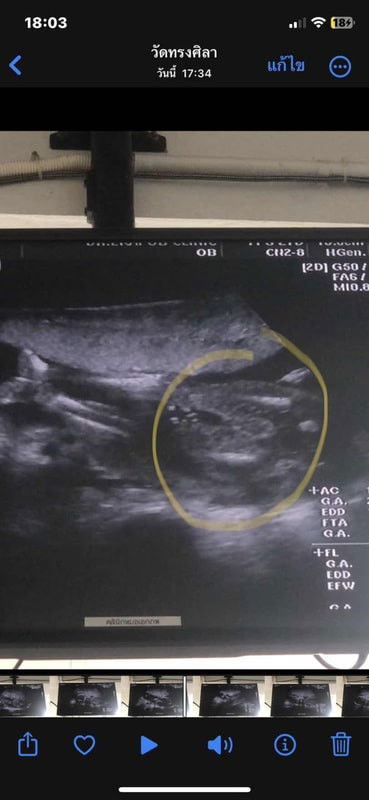 หมอบอกว่าเป็นผู้หญิง