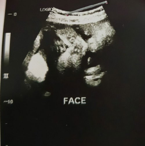 38 week scan