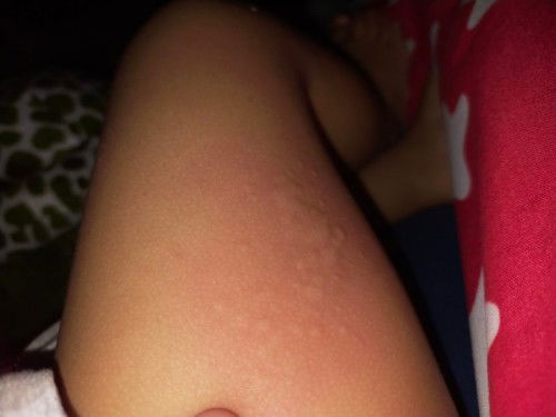 ตุ่มแบบนี้เกิดจากอะไรคะ?