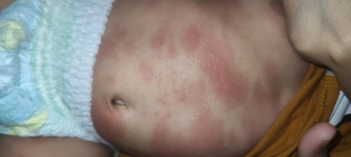 ใครมีลูกแล้วมีผื่นแบบนี้บ้างคะ ขอคำแนะนำหน่อยคะ
