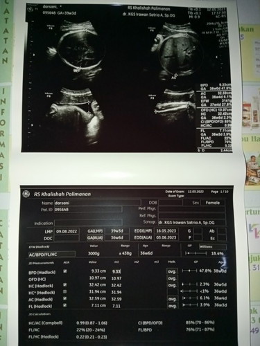 Apakah TB kurang dr 150cm bisa lahiran normal
