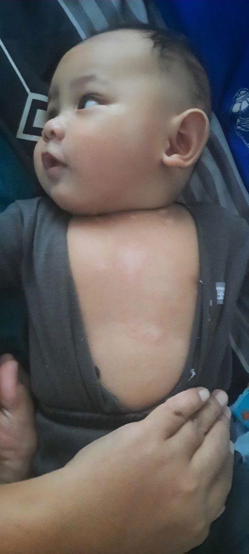 Ada Bercak putih di kulit Bayi