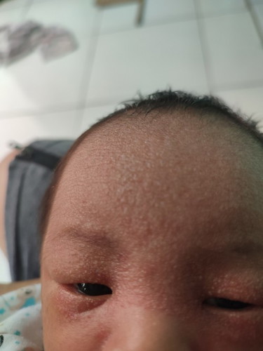 Mohon info bayi 5 hari beruntusan gini normal gak ya?