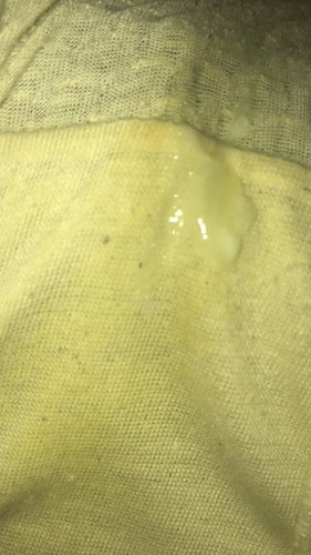 Metronidazole miconazole(Pinapasok sa pwerta)