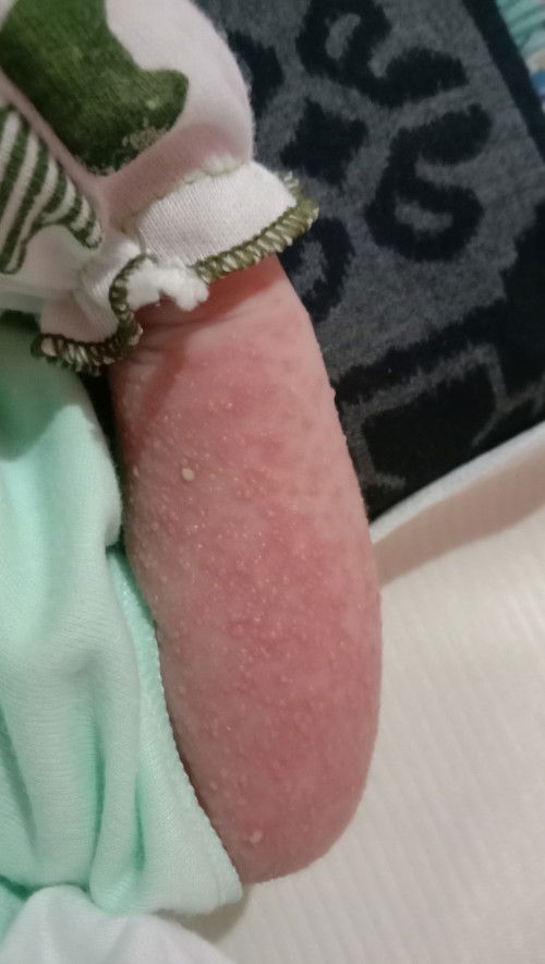 Bintik merah pada bayi usia 7 hari