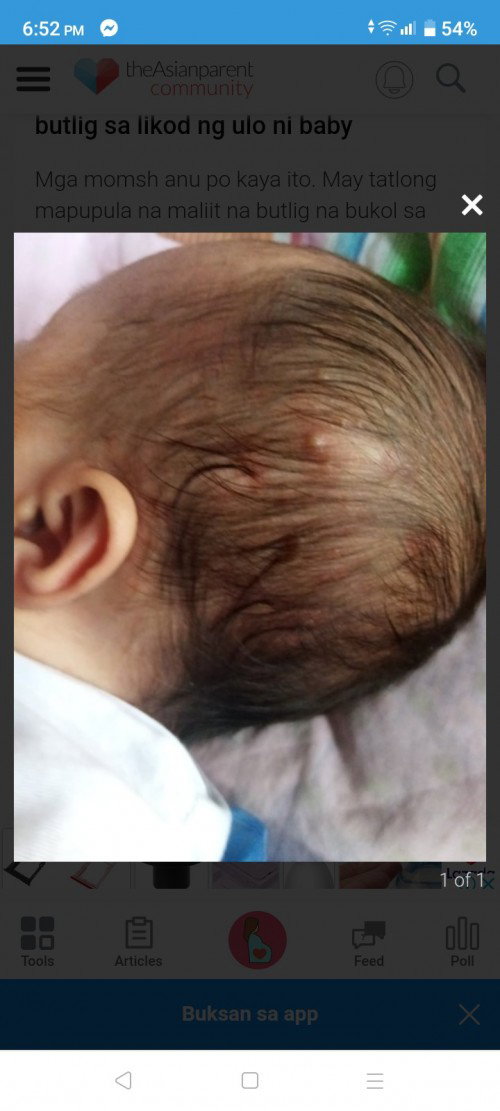 Bukol na namumula mula sa ulo ni baby