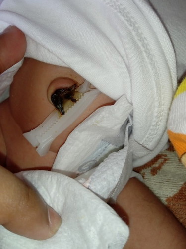 Umbilical Cord / Pusod ng Newborn