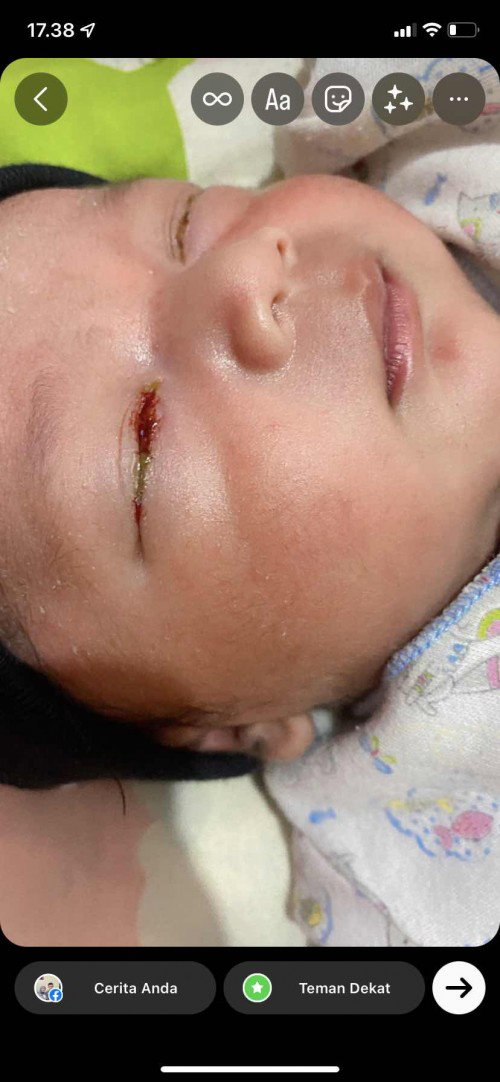 Mata anak berdarah