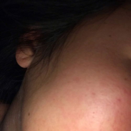 ท้อง34+5ผื่นขึ้น