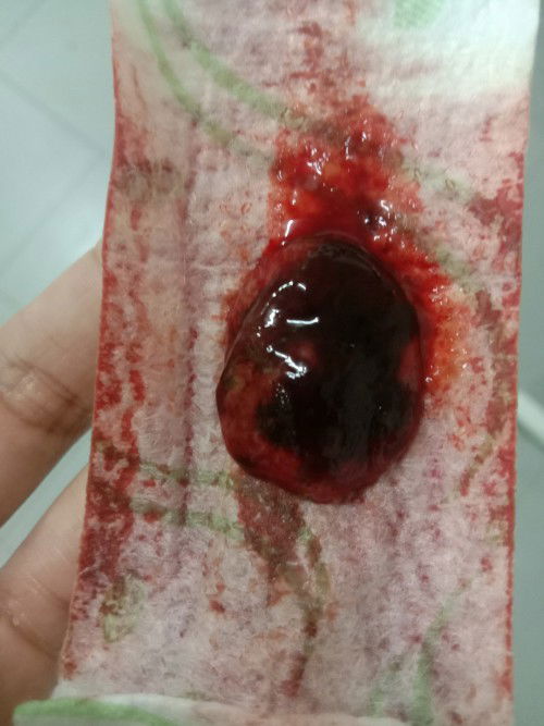 Kantung janin keguguran atau bukan?