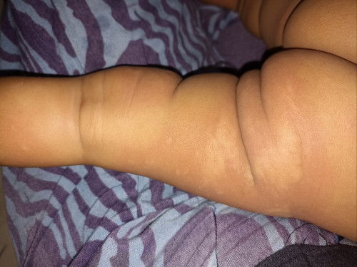 Bun ini babyku kenapa ya? Biduran kah? Usia 8m