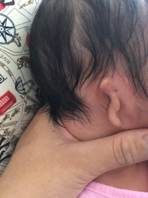 Microtia (ไมโครเทีย) เกรด3