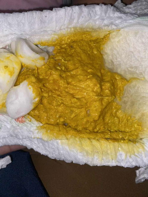 อึแบบนี้ปกติไหมคะ