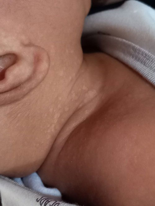 Buras, atau Ruam atau apa ?