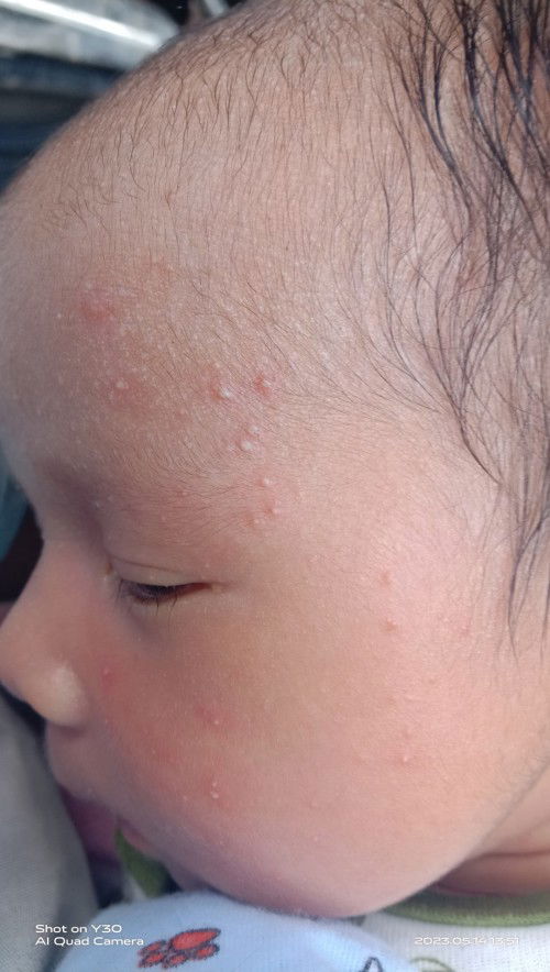 Beruntusan pada kulit bayi, obatnya apa ya😢