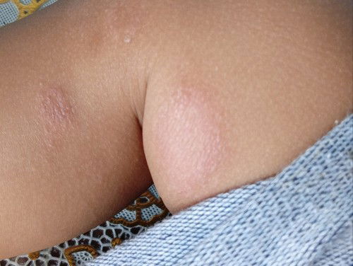 tanya obat/salep yang cocok