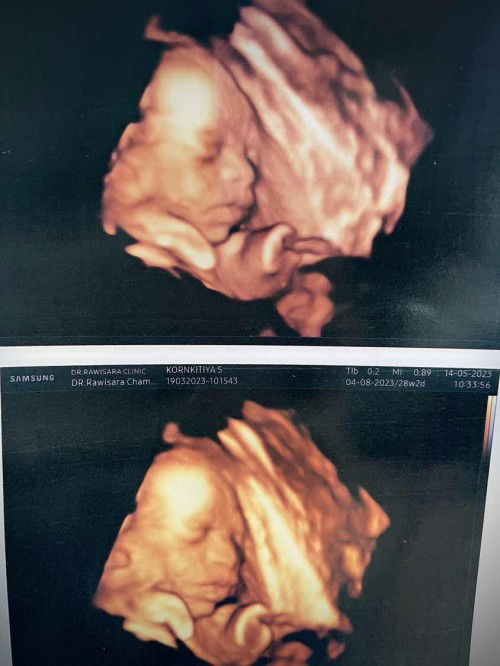 อัลตร้าซาวด์ 4 มิติ 28 W