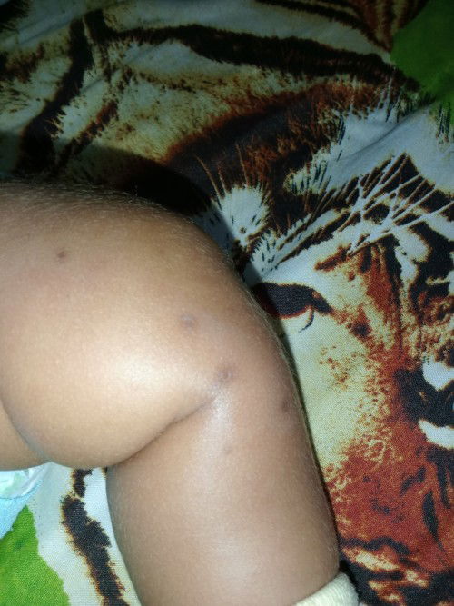 Cara menghilangkan bekas gigitan nyamuk pake apa ya