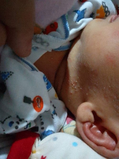 Bentol-bentol pada anak bayi